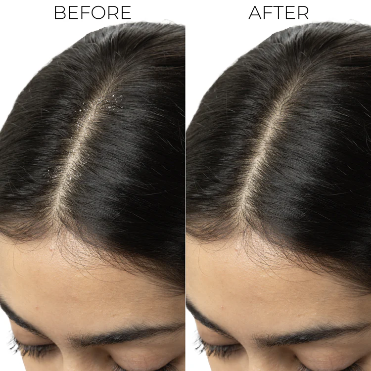 Dandruff Control Conditioner For Itchy, Flaky Scalp - Image 4