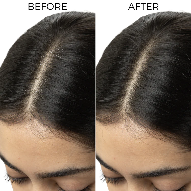 Tea Tree Hair Oil for Dandruff Control - Image 6